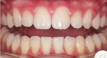 Orthodontie — Après