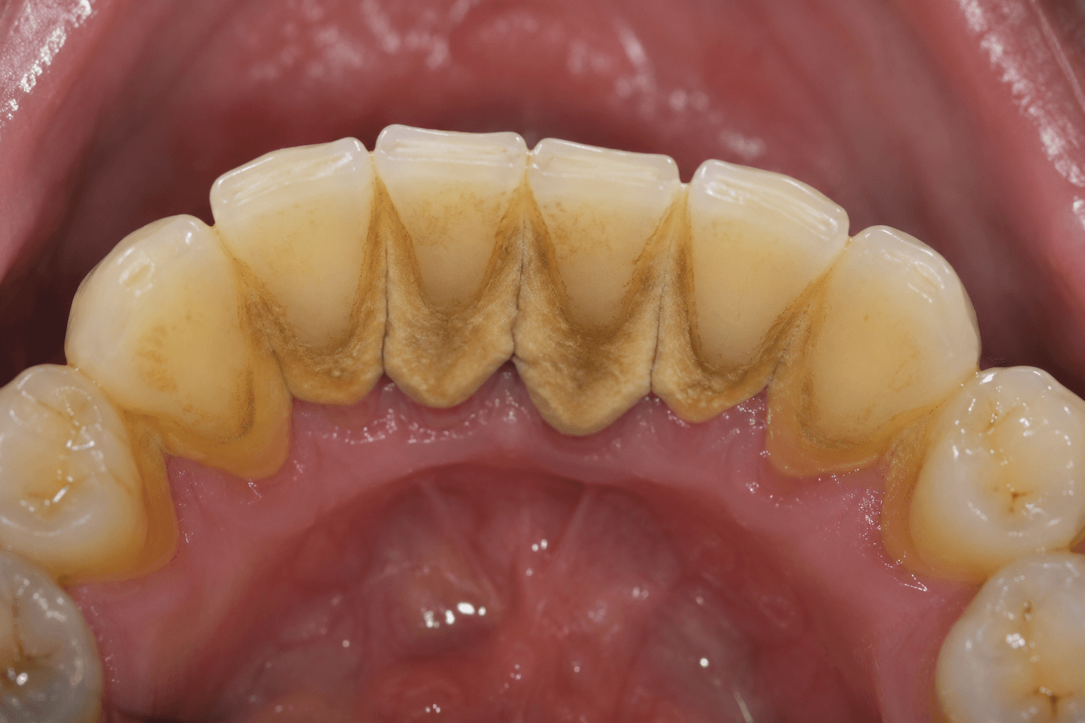 Détartrage — Centre El Mostaine Dental